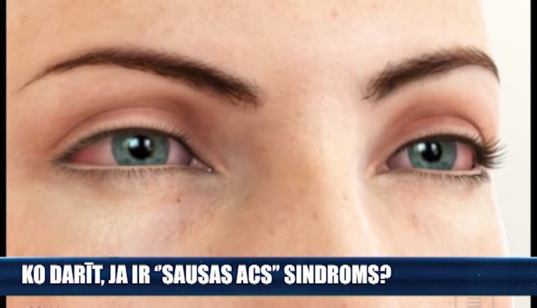 Ko darīt, ja ir "sausās acs" sindroms?