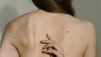 Kāda profilakse jāievēro attiecībā uz dzimumzīmēm, kas parādās dzīves laikā?